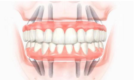 5 инновационных методов, как вставить зубы меньше, чем за неделю